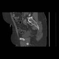 Acetabular fracture (Radiopaedia 13193-13212 Sagittal bone window 37).jpg