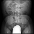 Achondroplasia (Radiopaedia 5867-7443 E 1).jpg