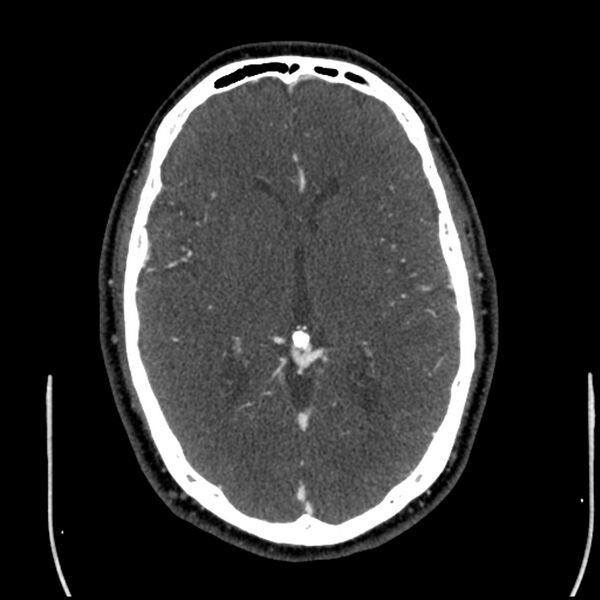 File:Acute A3 occlusion with ACA ischemic penumbra (CT perfusion) (Radiopaedia 72036-82527 Axial C+ arterial phase thins 73).jpg