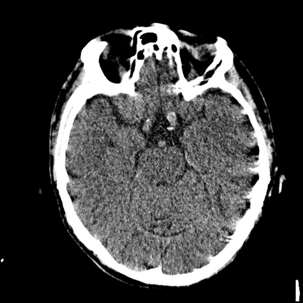 File:Acute P1 occlusion with PCA ischemia penumbra (CT perfusion) (Radiopaedia 72084-82586 Axial non-contrast thins 4).jpg