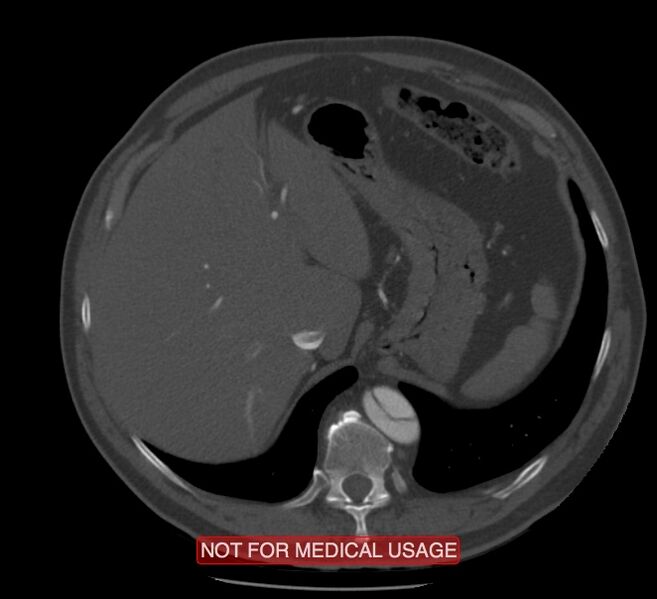 File:Acute aortic dissection - Stanford type A (Radiopaedia 40661-43285 Axial C+ arterial phase 73).jpg
