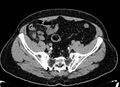 Acute appendicitis (Radiopaedia 13030-13091 Axial non-contrast 52).jpg