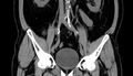 Acute appendicitis (Radiopaedia 13030-13091 Coronal non-contrast 13).jpg