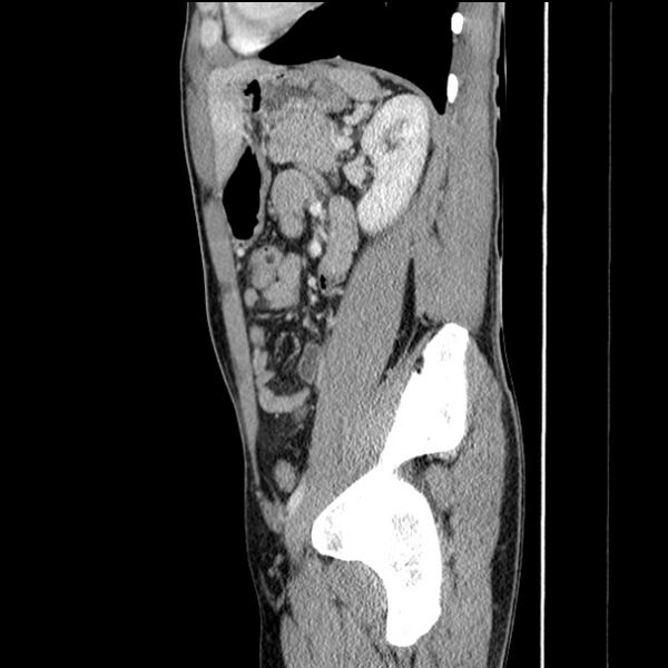 File:Acute appendicitis (Radiopaedia 27049-27227 Sagittal C+ portal venous phase 55).jpg