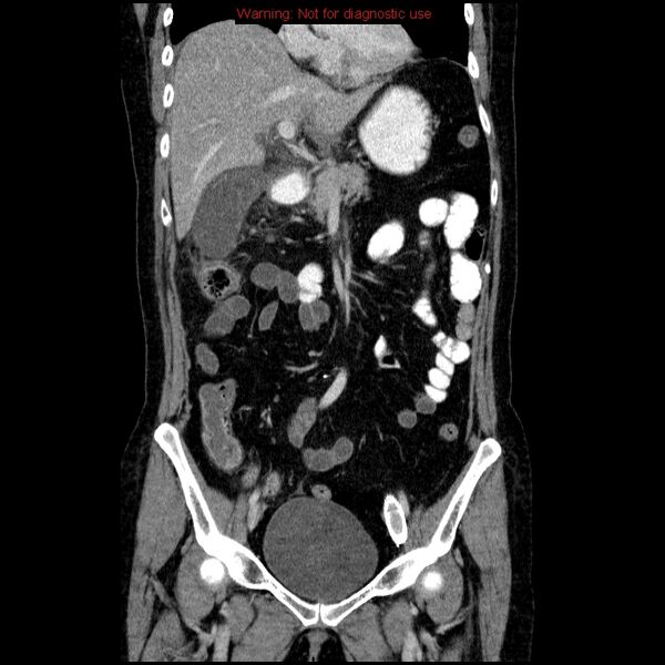 File:Acute gangrenous cholecystitis (Radiopaedia 10123-10661 Coronal C+ portal venous phase 9).jpg