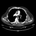 Acute heart failure (CT) (Radiopaedia 79835-93075 Axial C+ arterial phase 11).jpg