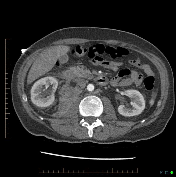 File:Acute hemorrhage into adrenal metastasis from NSCLC (Radiopaedia 43135-46429 Axial C+ arterial phase 13).jpg