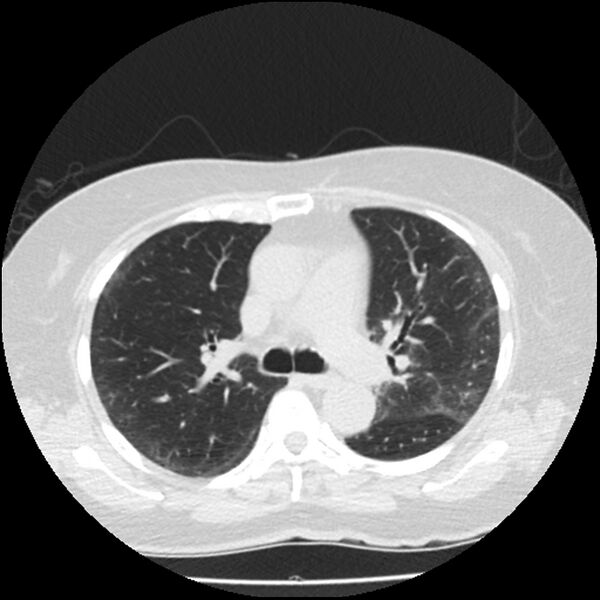 File:Acute interstitial pneumonitis (Radiopaedia 45404-49444 Axial lung window 43).jpg