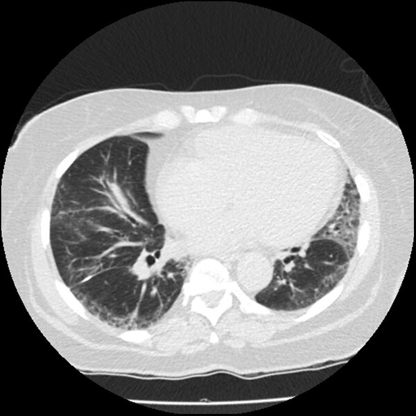 File:Acute interstitial pneumonitis (Radiopaedia 45404-49444 Axial lung window 68).jpg