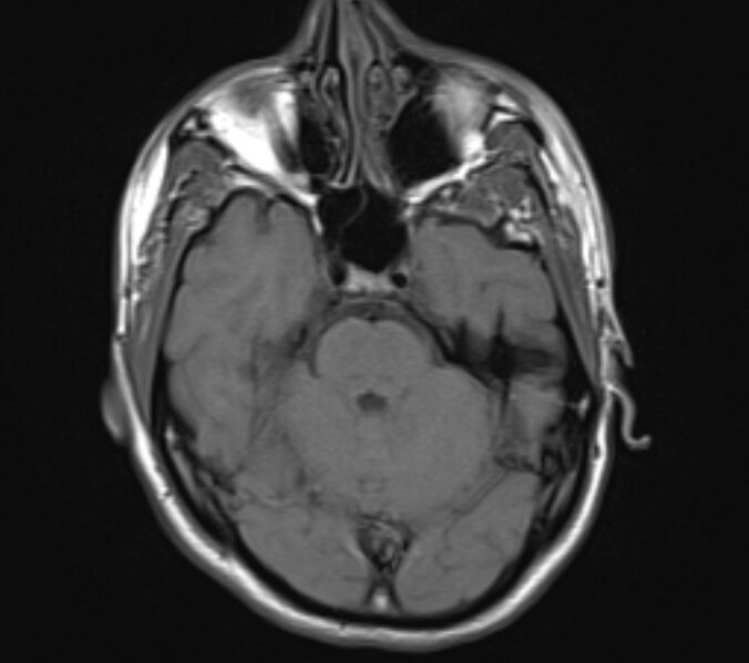 File:Acute ischemic stroke - posterior circulation territory (Radiopaedia 77670-89880 Axial T1 8).jpg