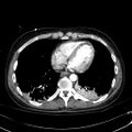 Acute myocardial infarction in CT (Radiopaedia 39947-42415 Axial C+ arterial phase 99).jpg