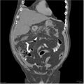 Acute pancreatitis (Radiopaedia 19135-19116 Coronal non-contrast 10).jpg