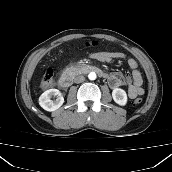 File:Acute pancreatitis (Radiopaedia 22572-22596 Axial C+ arterial phase 37).jpg