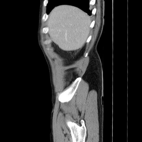 File:Acute pancreatitis (Radiopaedia 22572-22596 Sagittal C+ portal venous phase 8).jpg