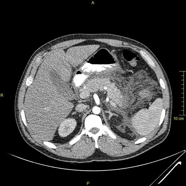 File:Acute pancreatitis (Radiopaedia 23231-23290 Axial C+ arterial phase 29).JPG