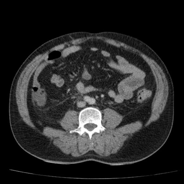 File:Acute pancreatitis (Radiopaedia 26663-26813 Axial C+ portal venous phase 53).jpg