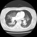 Acute pulmonary edema on CT (Radiopaedia 33582-34672 Axial lung window 24).jpg