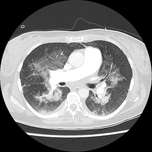 File:Acute pulmonary edema on CT (Radiopaedia 33582-34672 Axial lung window 24).jpg