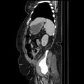 Acute pyelonephritis (Radiopaedia 25657-25837 Sagittal renal parenchymal phase 62).jpg