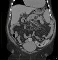 Acute renal failure post IV contrast injection- CT findings (Radiopaedia 47815-52557 Coronal non-contrast 14).jpg