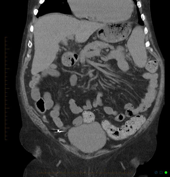 File:Acute renal failure post IV contrast injection- CT findings (Radiopaedia 47815-52557 Coronal non-contrast 14).jpg
