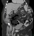 Acute renal failure post IV contrast injection- CT findings (Radiopaedia 47815-52559 Coronal C+ portal venous phase 5).jpg