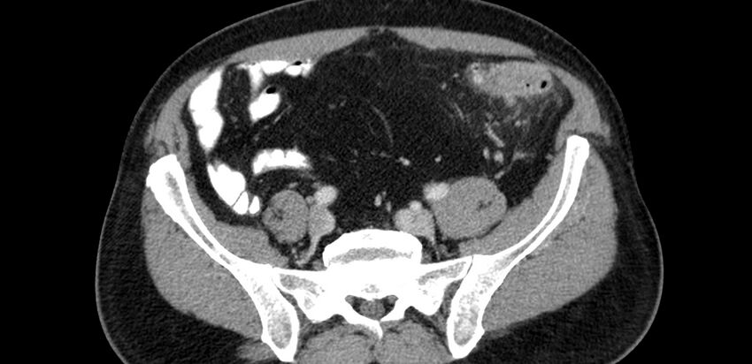 Acute sigmoid colon diverticulitis (Radiopaedia 55507-61976 Axial C+ portal venous phase 68).jpg