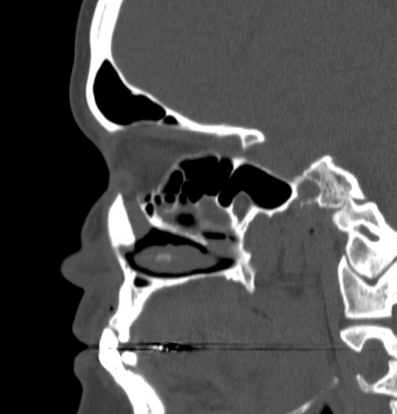 File:Acute sinusitis (Radiopaedia 22419-22455 Sagittal non-contrast 17).jpg