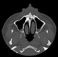 Acute sinusitis (Radiopaedia 23161-23215 Axial bone window 14).jpg
