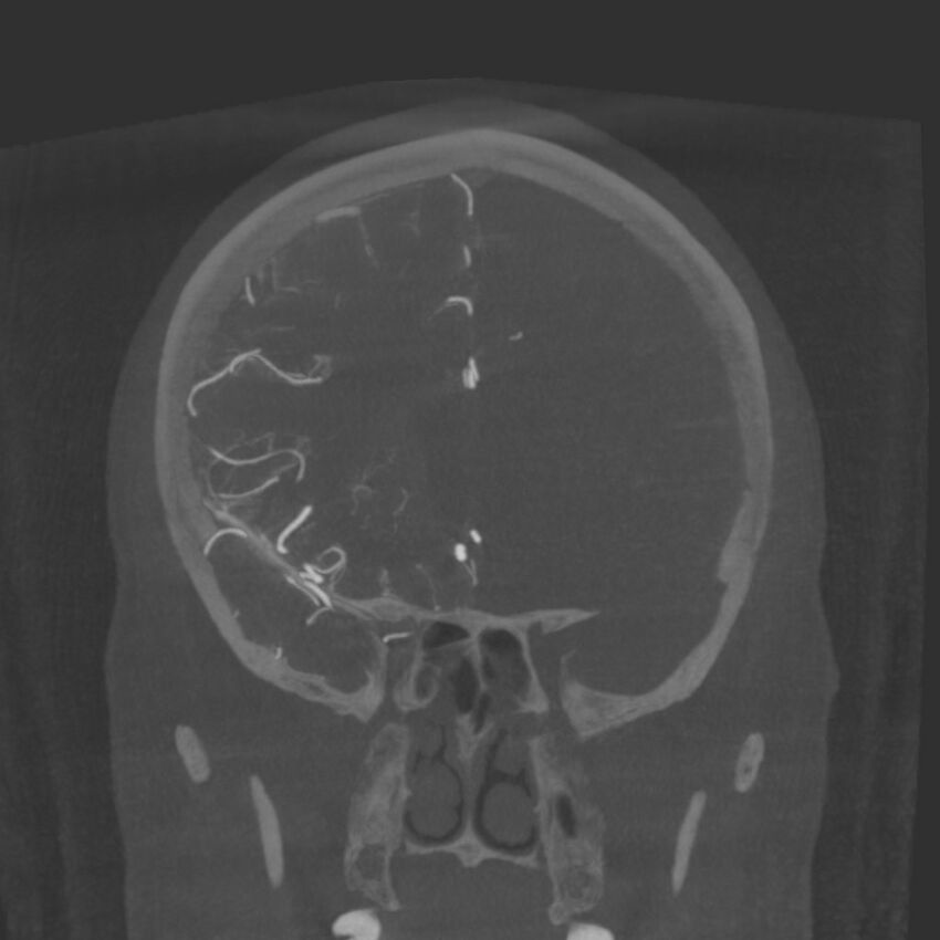 Acute subarachnoid hemorrhage and accessory anterior cerebral artery (Radiopaedia 69231-79010 Coronal arterial - MIP 35).jpg