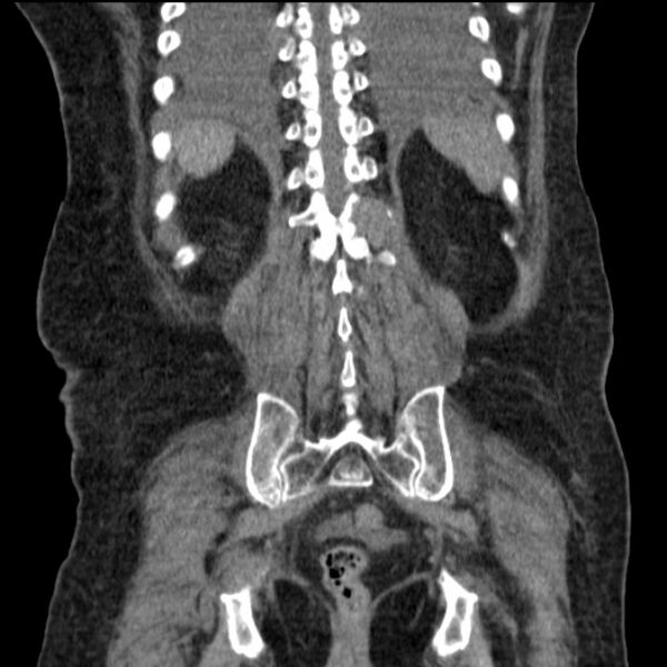 File:Acute tubular necrosis (Radiopaedia 28077-28334 D 67).jpg