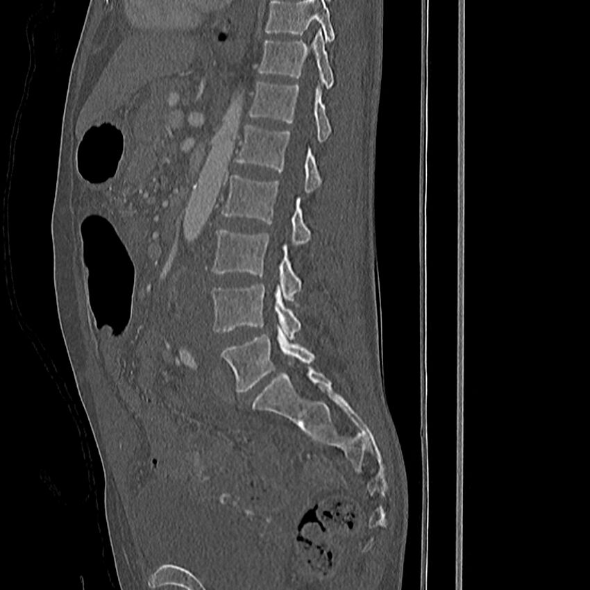 Acute vertebral body compression fractures (Radiopaedia 31757-32693 Sagittal bone window 21).jpg