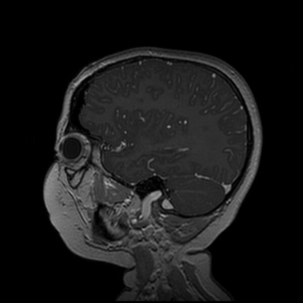 File:Adamantinomatous craniopharyngioma (Radiopaedia 77407-89529 H 33).jpg