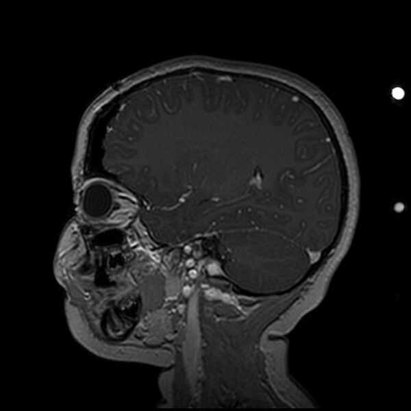 File:Adamantinomatous craniopharyngioma (Radiopaedia 77407-89529 H 41).jpg
