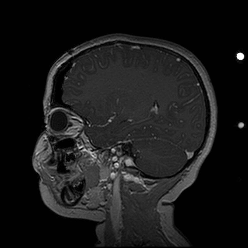 Adamantinomatous craniopharyngioma (Radiopaedia 77407-89529 H 41).jpg