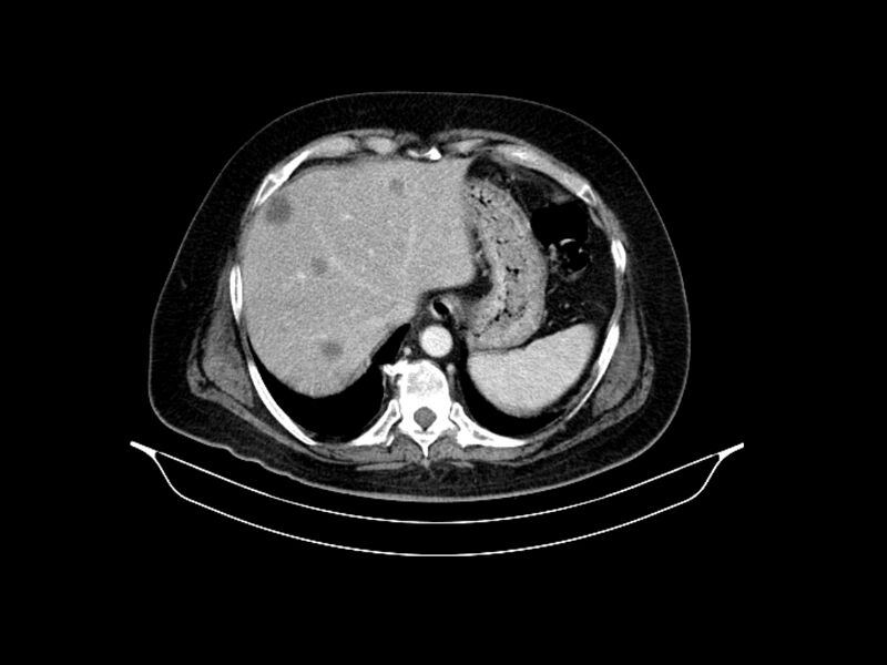 File:Adenocarcinoma of pancreas with hepatic metastasis (Radiopaedia 64332-73122 Axial C+ portal venous phase 20).jpg