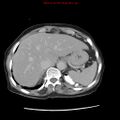 Adenocarcinoma of the colon (Radiopaedia 8191-9039 Axial renal excretory phase 1).jpg