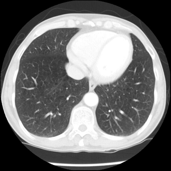 File:Adenocarcinoma of the lung - micropapillary predominant (Radiopaedia 42446-45563 Axial lung window 56).jpg