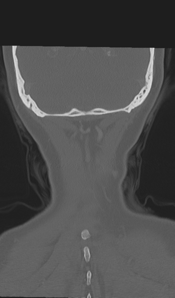 File:Adenoid cystic tumor of palate (Radiopaedia 46980-51518 Coronal bone window 54).png