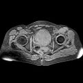 Adenomyoma of the uterus (huge) (Radiopaedia 9870-10438 Axial T1 fat sat 10).jpg