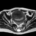 Adenomyoma of the uterus (huge) (Radiopaedia 9870-10438 Axial T2 26).jpg