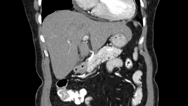 File:Adenomyomatosis of the gallbladder (Radiopaedia 12142-12483 Coronal C+ arterial phase 14).jpg