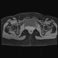 Adenomyosis and endometriotic cysts (Radiopaedia 82300-96367 Axial T1 C+ fat sat 3).jpg
