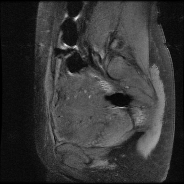File:Adenomyosis on MRI (Radiopaedia 29328-29780 Sagittal T1 fat sat 13).jpg