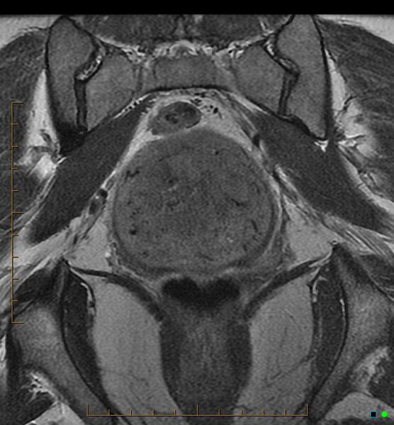 File:Adenomyosis uterus with hematometra (Radiopaedia 45779-50011 Coronal T2 19).jpg