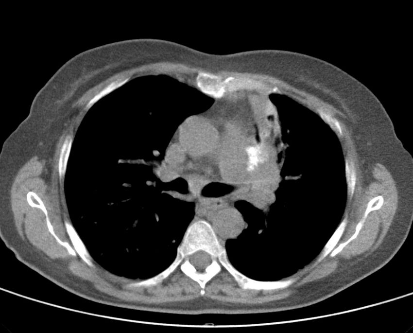 Adenosquamous lung carcinoma (Radiopaedia 22035-22030 non-contrast 28).jpg
