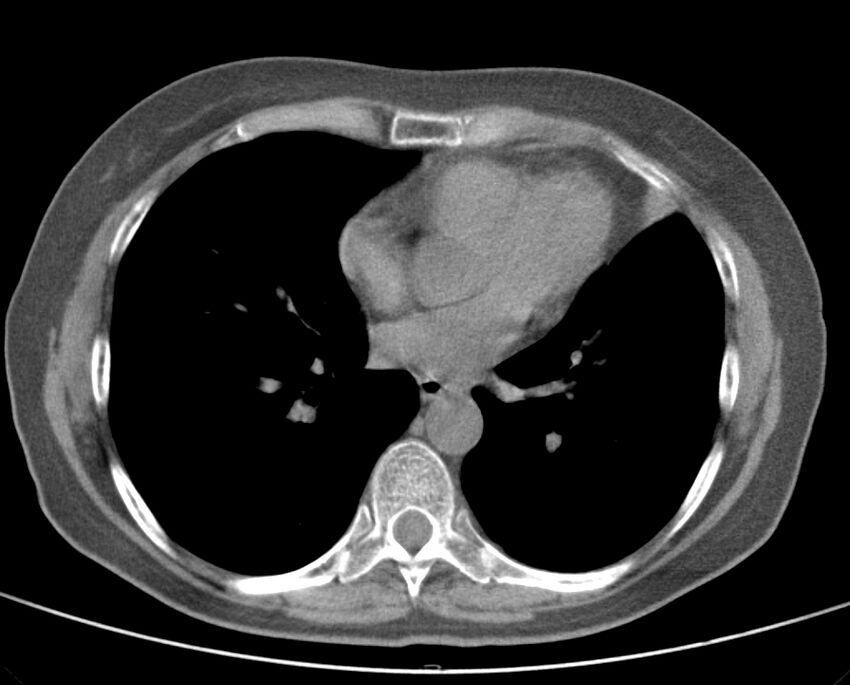 Adenosquamous lung carcinoma (Radiopaedia 22035-22030 non-contrast 37).jpg