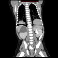 Adrenal hemorrhage (Radiopaedia 9390-10077 Coronal C+ portal venous phase 9).jpg
