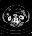 Adrenal myelolipoma (Radiopaedia 6765-7960 Axial C+ arterial phase 19).jpg