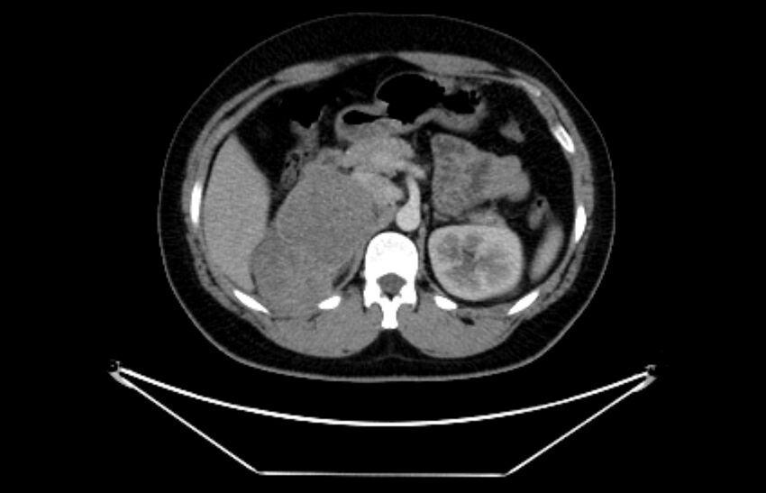 Adrenocortical carcinoma (Radiopaedia 80134-93438 Axial C+ portal venous phase 46).jpg